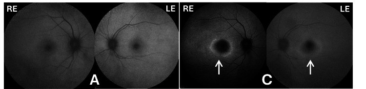 Fundus autofluorescence of both eyes: even in 2017, and a bright ring around a dark center in 2023 from hydroxychloroquine toxicity