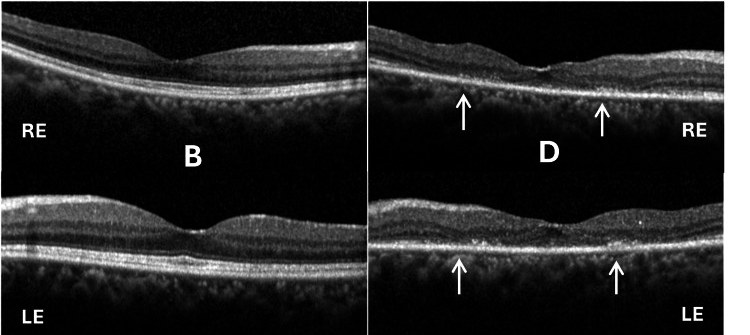 OCT scans of both eyes: normal retinal layers in 2017, and loss of the outer retina on either side of the center in 2023 from hydroxychloroquine toxicity