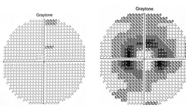 Grayscale visual field maps: nearly normal in 2020, and a dark ring of lost vision around the center in 2023 from hydroxychloroquine toxicity