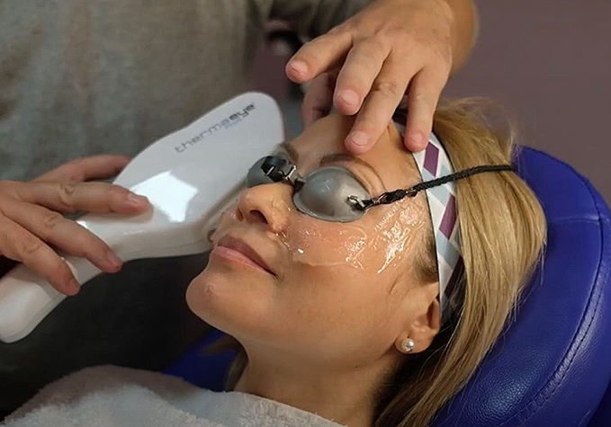 IPL dry eye treatment at Everyday Eye Care