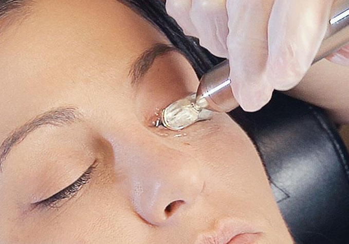 MiBo Thermoflo treatment for dry eye